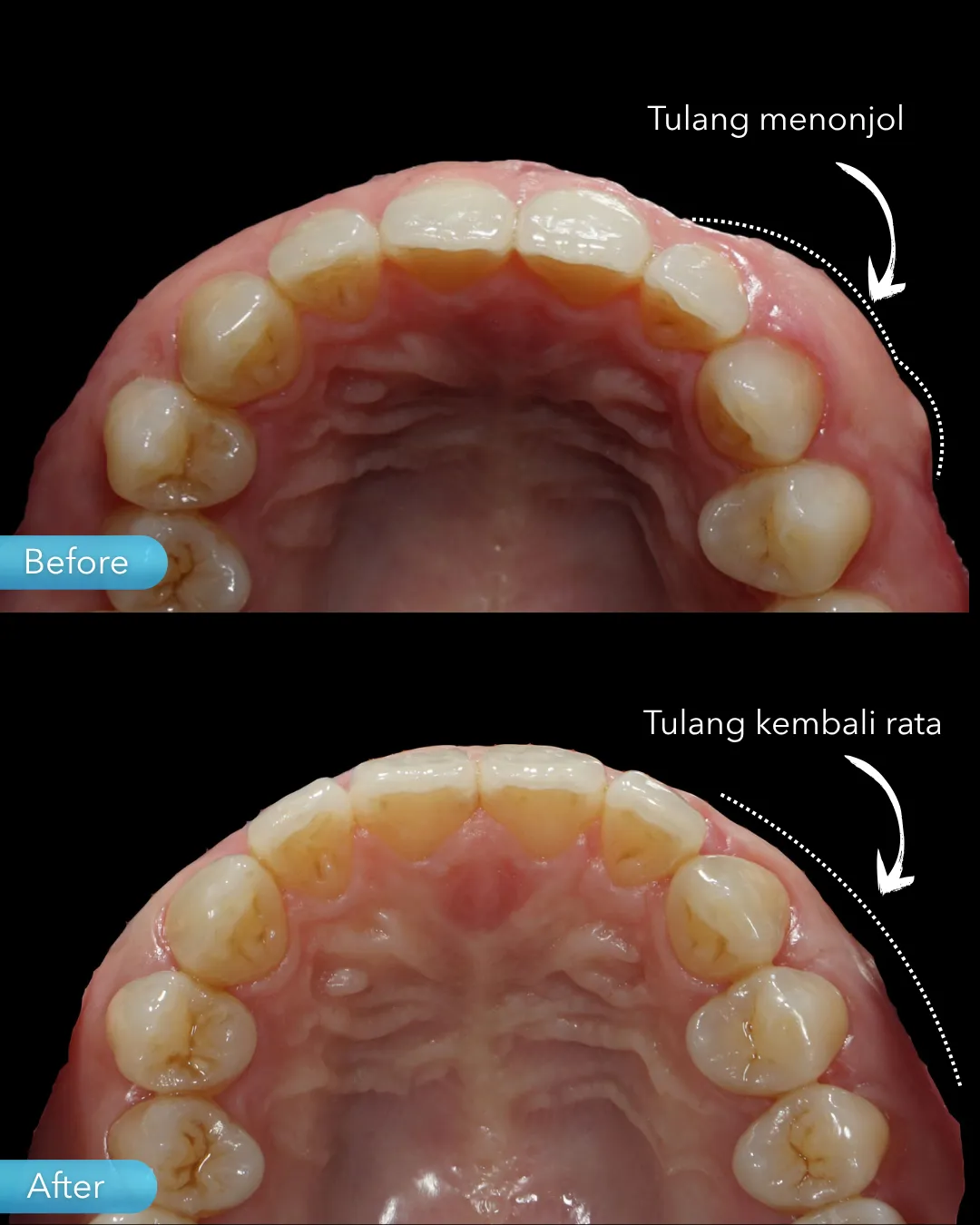 Gum surgery result